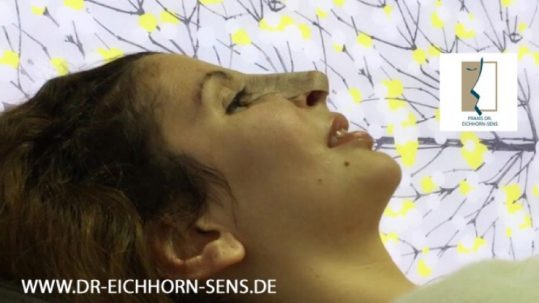 Durch Tapen nach der Rhinoplastik von Dr. Eichhorn-Sens läßt sich die Forn der Nase noch selbst beeinflussen